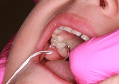 Odstranění mezizubních kazů a restaurace zubu(4 roky)